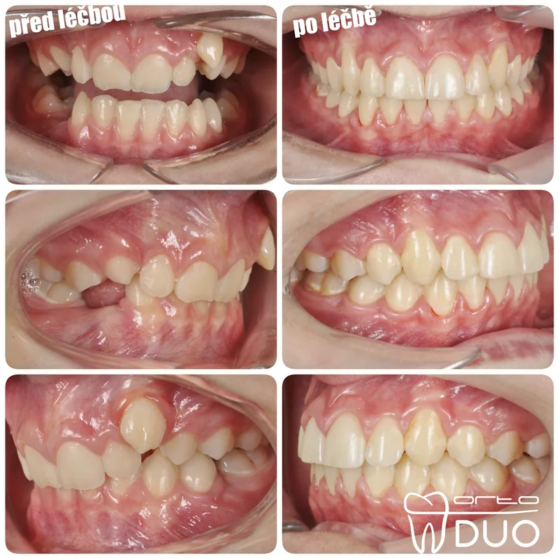 Hluboký skus + stěsnání — před a po léčbě