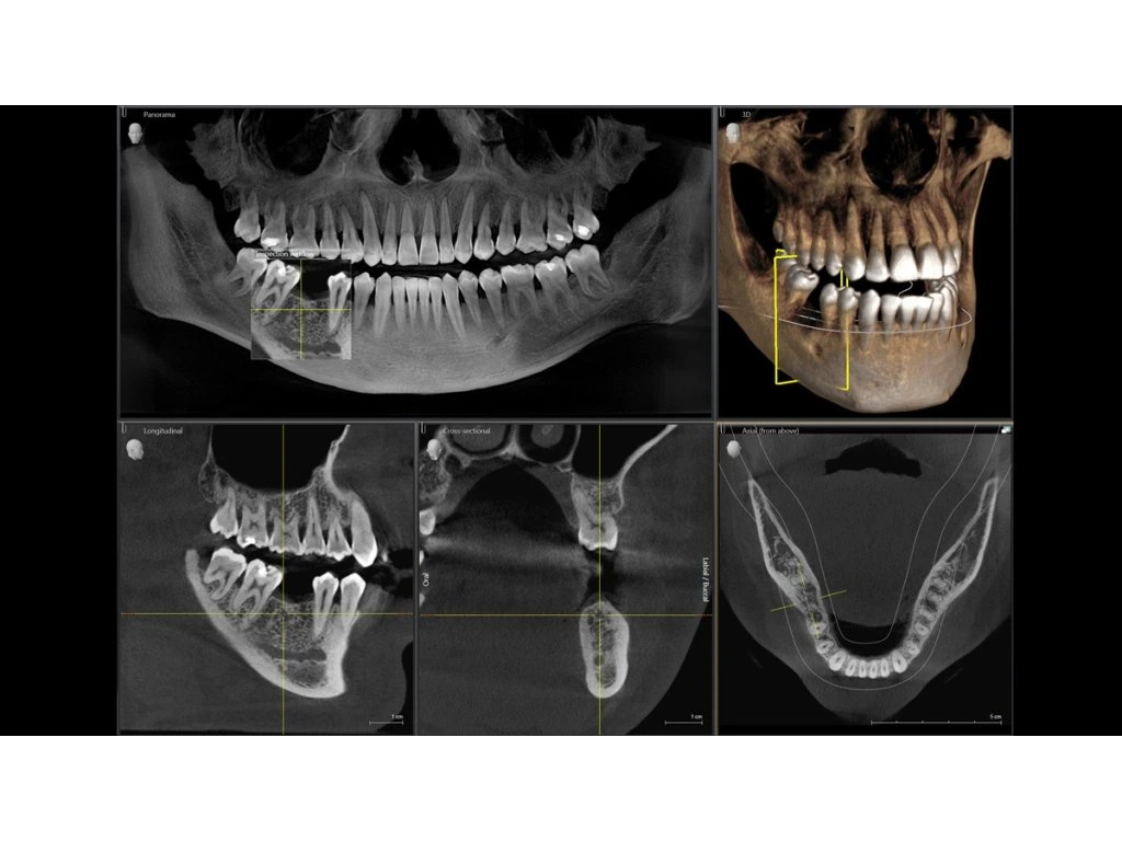 3D CBCT sken čelisti